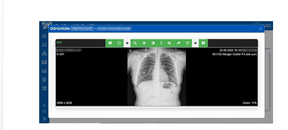 e-Nabız Akciğer Görüntüleme